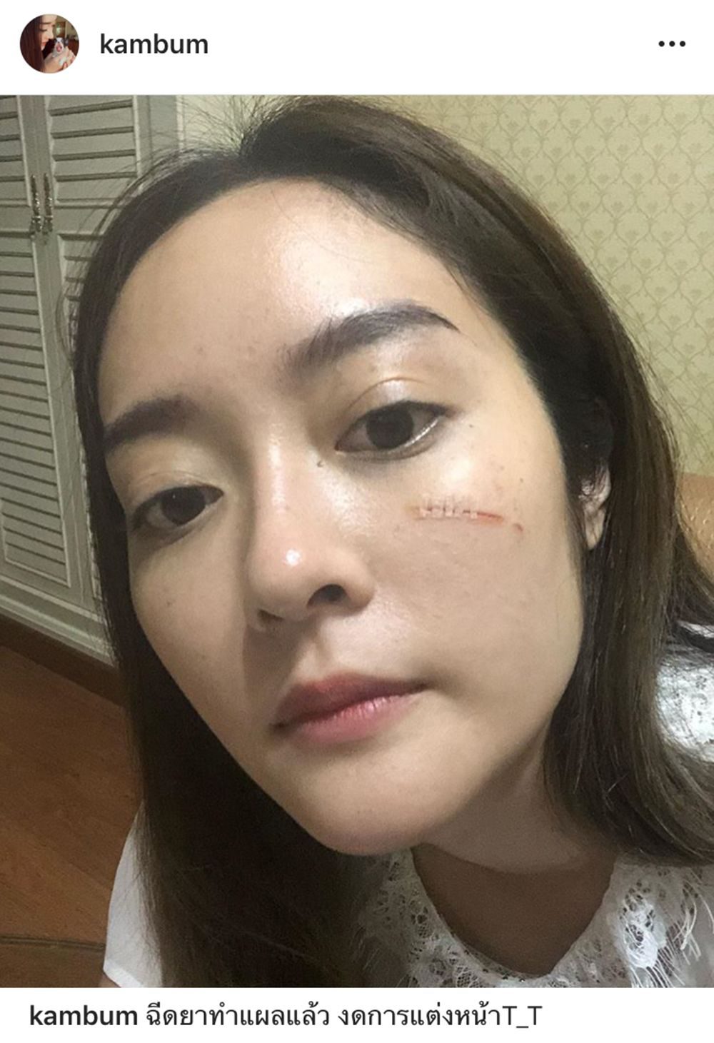 อัปเดตล่าสุดฉีดยาทำแผลเรียบร้อยแล้ว