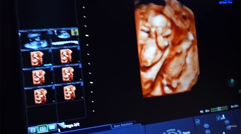 ภาพอัลตร้าซาวด์ 4D ลูกแฝด ป๊อก-มาร์กี้