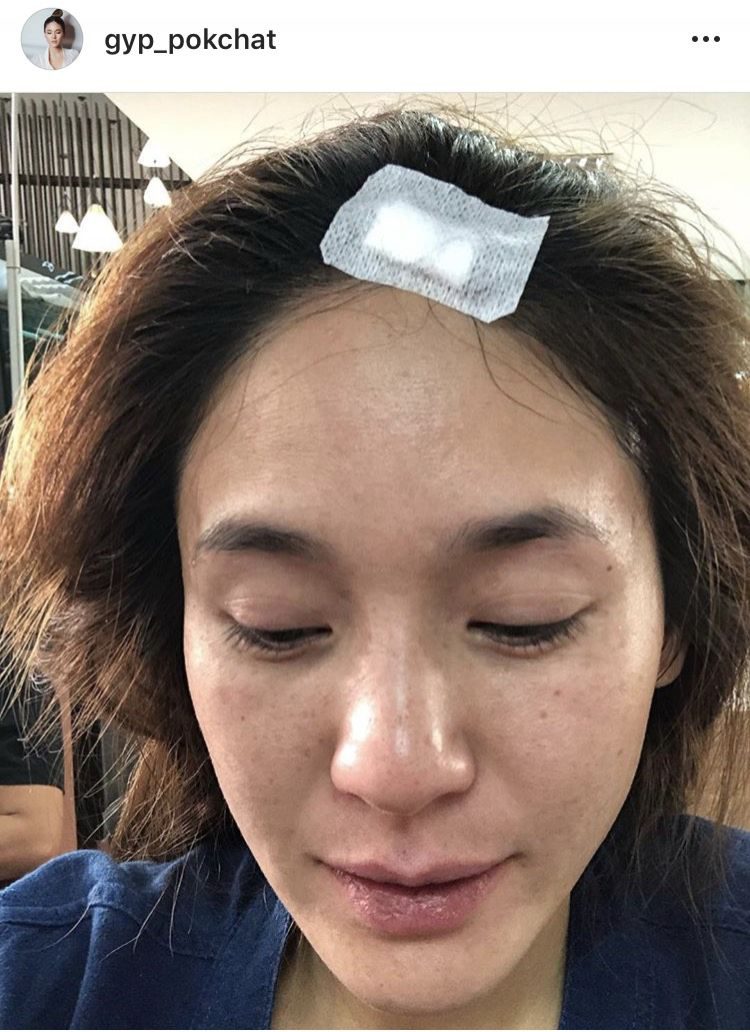 จิ๊ป ปกฉัตร ล้มหัวฟาดขอบรถตู้